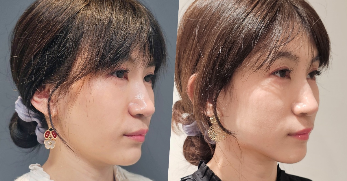 佳飛雅緻美學┃台北中山。海芙電波讓整個臉部輪廓更顯少女感，維持青春的小秘密