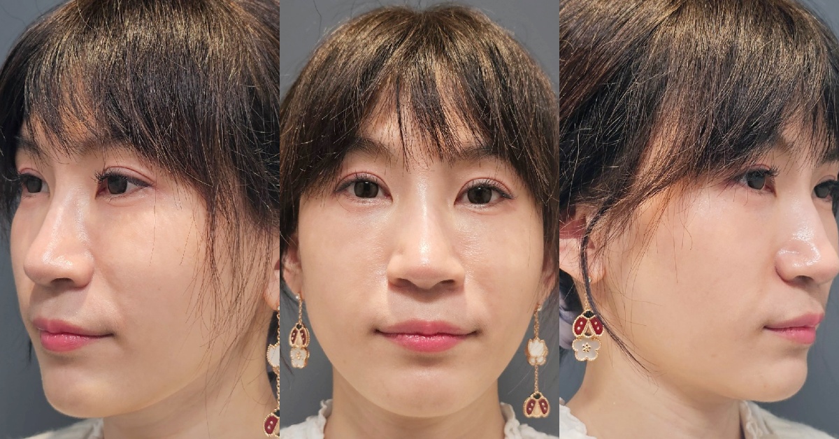 佳飛雅緻美學┃台北中山。海芙電波讓整個臉部輪廓更顯少女感，維持青春的小秘密
