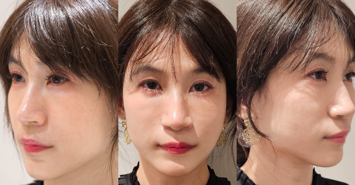 佳飛雅緻美學┃台北中山。海芙電波讓整個臉部輪廓更顯少女感，維持青春的小秘密