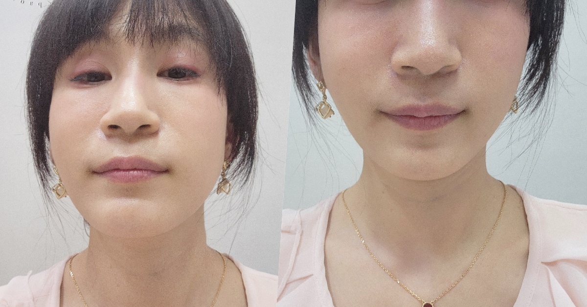 名悅時尚診所┃松山區醫美診所。臉部線條更柔美，無修復期讓你偷偷變漂亮，無死角更有自信