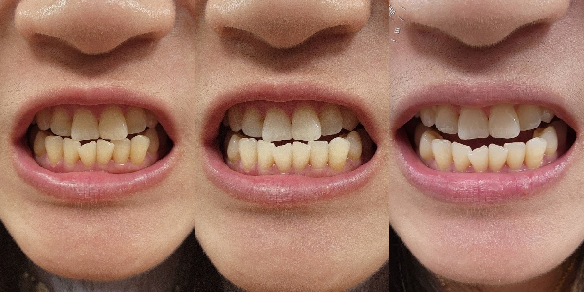 睡一覺牙齒就變白？睡前【 居家美白 】牙齒美白紀錄，牙齒變白過程分享｜竹北品悅牙醫診所｜新竹牙齒美白推薦