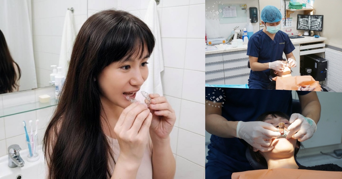 受保護的內容: 睡一覺牙齒就變白？睡前 【 居家美白 】 牙齒美白紀錄，牙齒變白過程分享｜竹北品 悅牙醫診所｜新竹牙齒美白推薦 @米寶麻幸福滿載