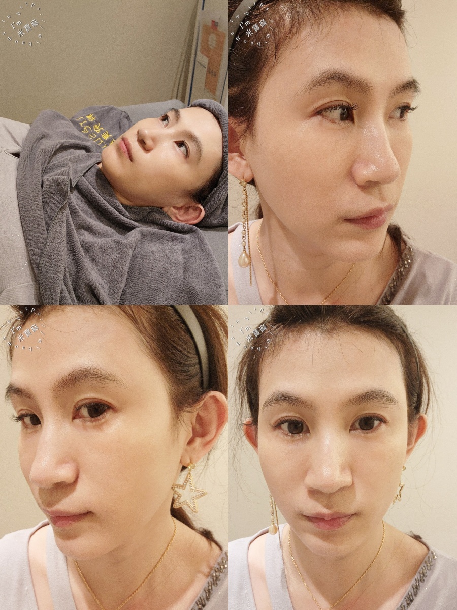 粹究美學鳳凰光：無痛動態養膚體驗，中山區醫美推薦的真實心得