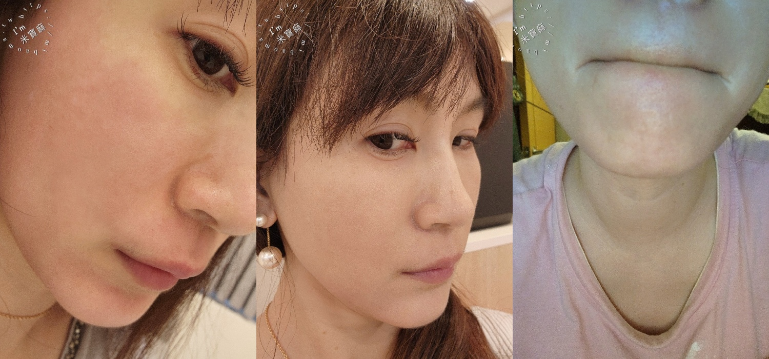 粹究美學鳳凰光：無痛動態養膚體驗，中山區醫美推薦的真實心得